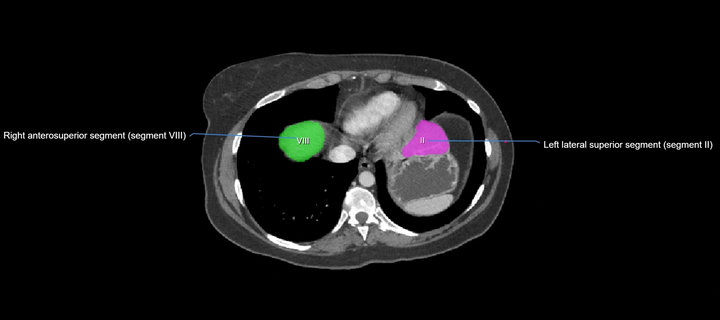 CT liver segments axial cross sectional anatomy labelled image-00074.webp